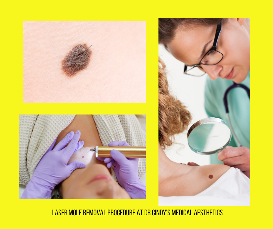 Laser-Mole-removal-Procedure-at-Dr-Cindys-Medical-Aesthetics.