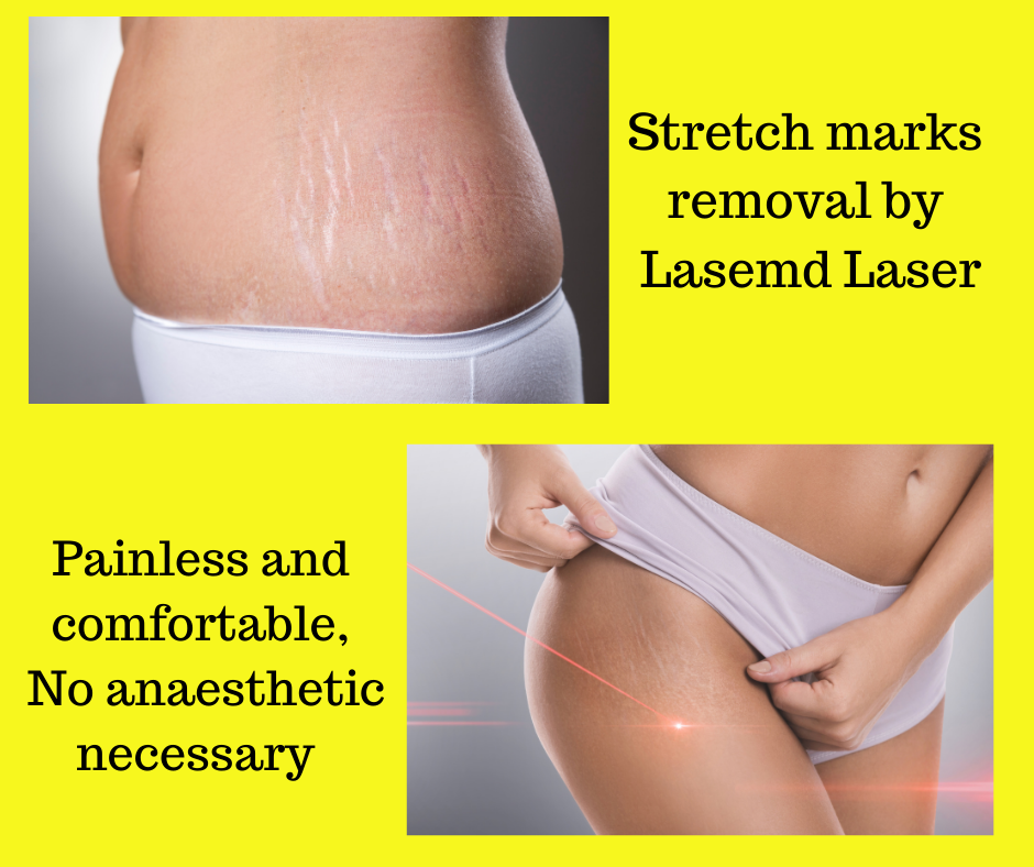 Stretch marks can be remove effectively by lasemd laser at Dr Cindy's Medical Aesthetics 