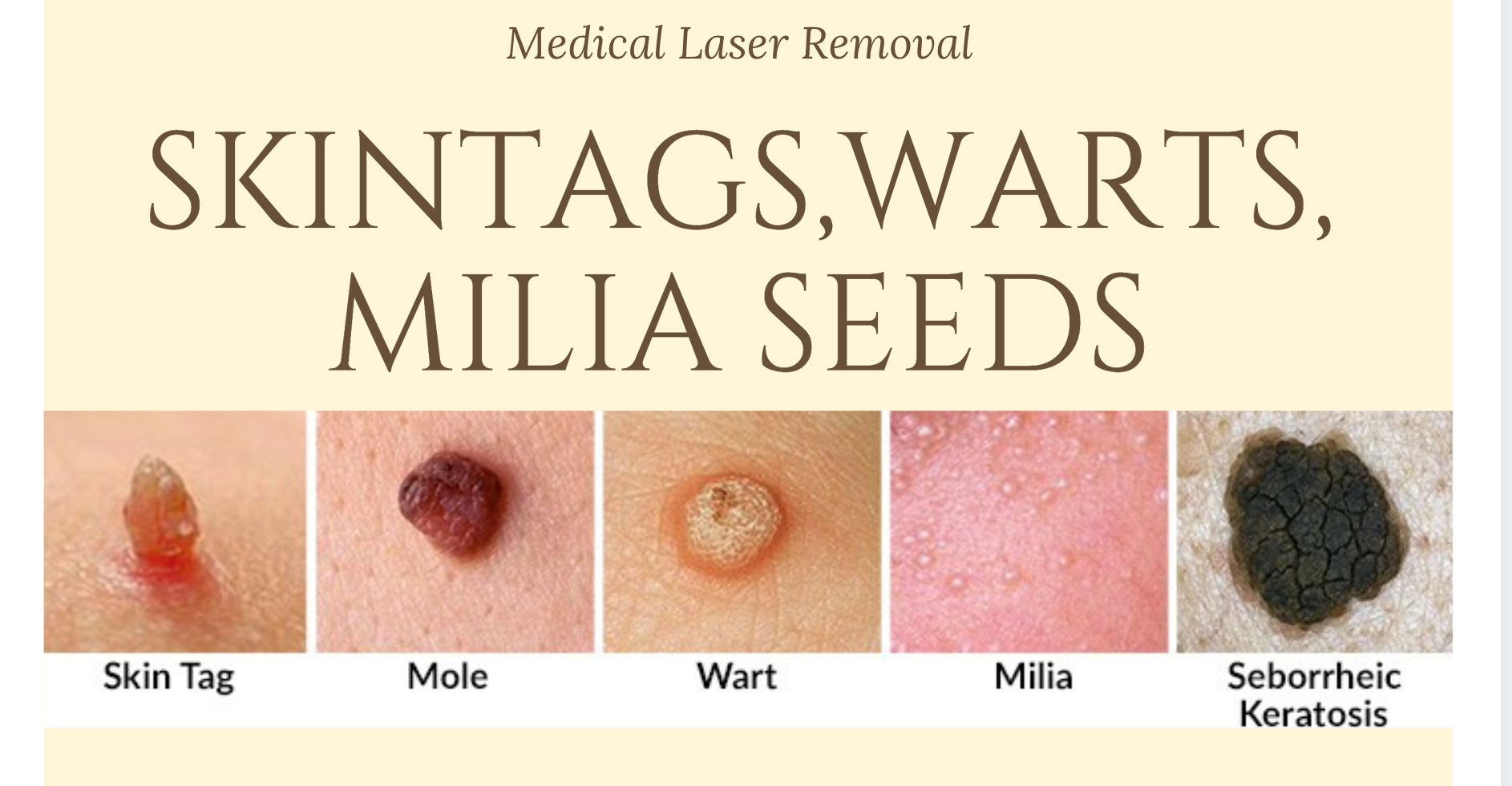 Laser removal of skin tags, wart and moles at Dr Cindy's Medical Aesthetics 